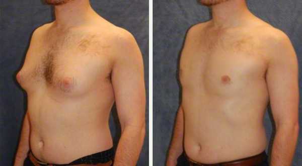 Get Rid Of Gyno With Surgery